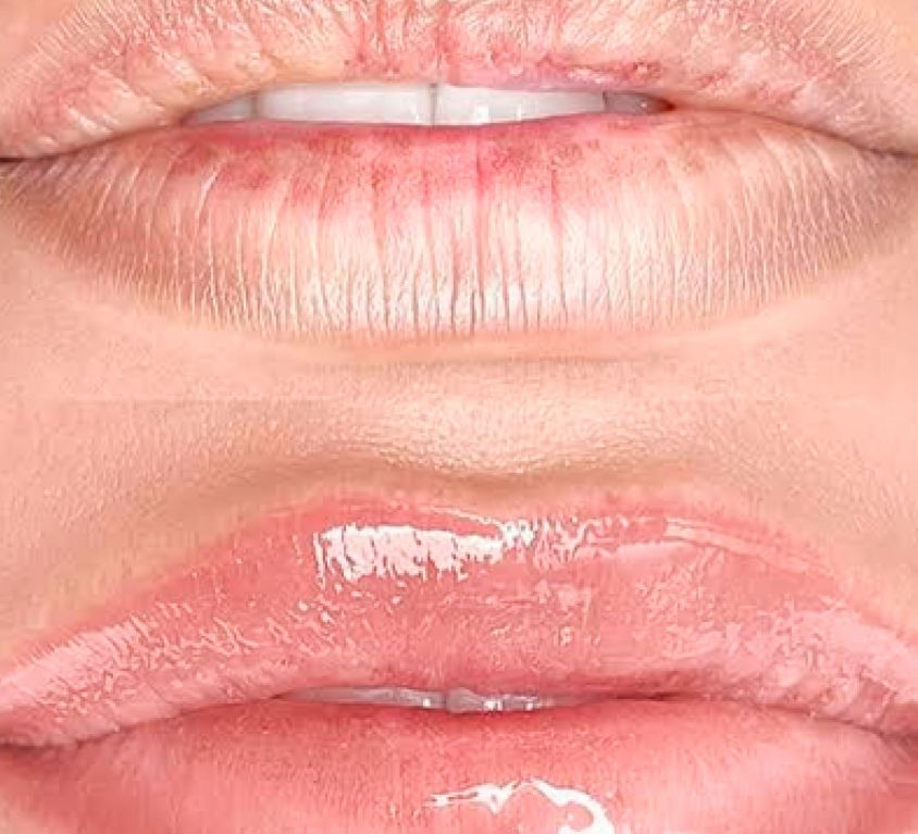 Lips Repair